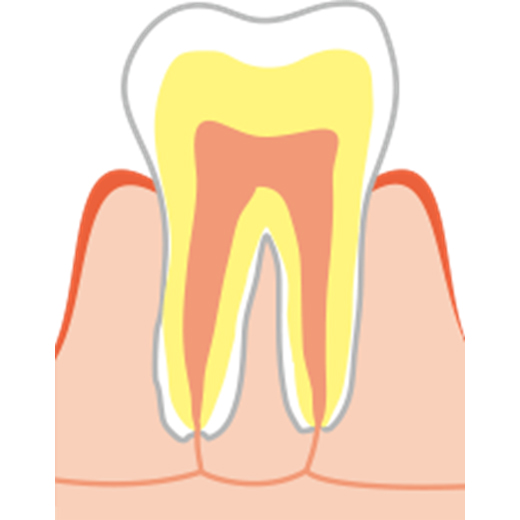 虫歯治療