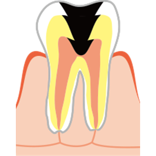 虫歯治療