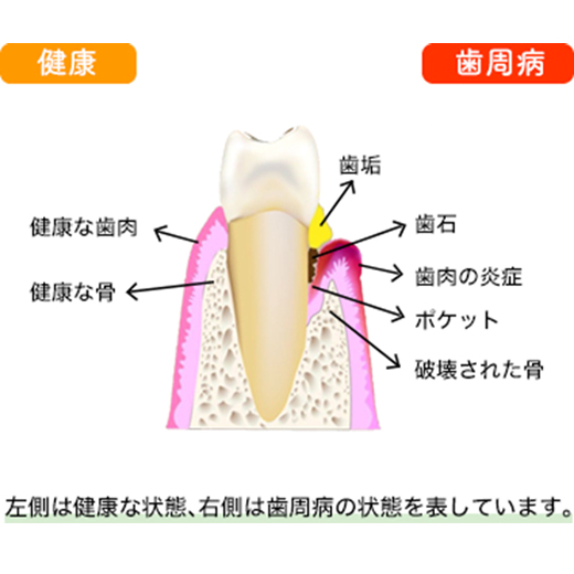 歯周病